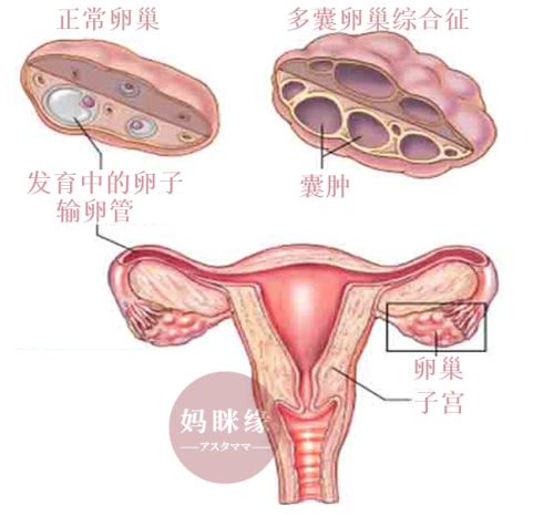 Polycystic Ovary Syndrome 多囊卵巢综合征导致卵巢性闭经和不孕