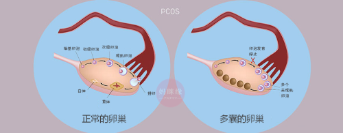 沉稳 20岁女孩多囊卵巢怎么办为你介绍