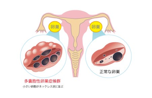 多囊卵巢综合征